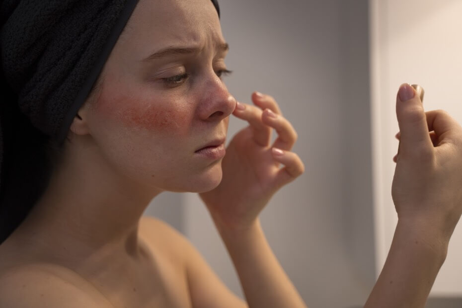 Los coaches de Foriu te harán un maquillaje adecuado para tu piel con rosácea.